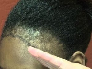How to Grow Back Your Hairline